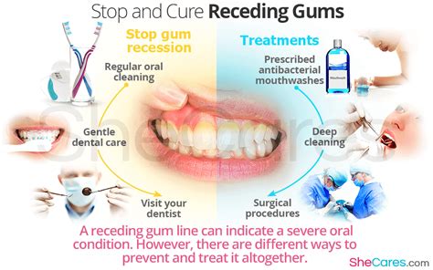 stop  cure reciding gums gum treatment receding gums gum