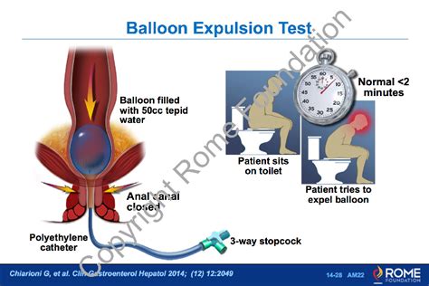 Anorectal 28 Balloon Expulsion Test Rome Online