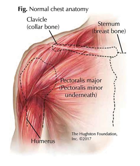 chest muscle injuries strains  tears   pectoralis major