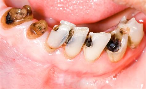 common symptoms  tooth decay