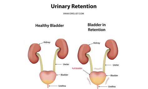 urinary retention and what you need to know