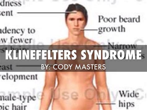 Klinefelter Syndrome Diseasemaps The Best Porn Website