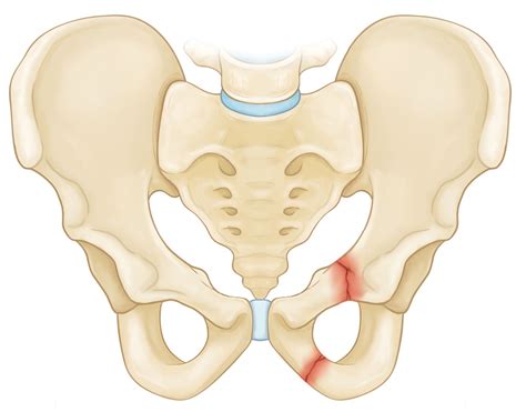 pelvic fractures orthoinfo aaos