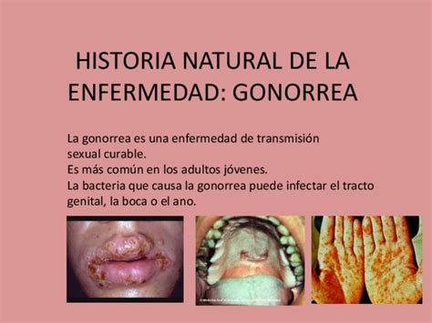 Historia Natural De La Enfermedad Gonorrea