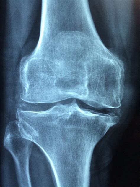 artificial cartilage gel strong   replace damaged knee tissue ibtimes
