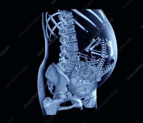 full term foetus ct scan stock image  science photo library