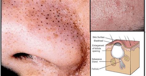 apply   natural remedies  remove blackheads    minutes