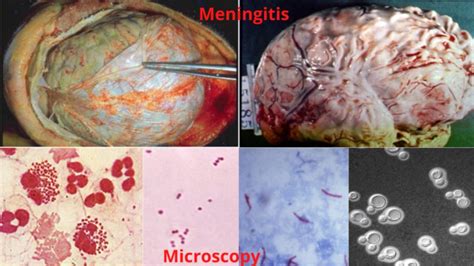 Meningitis Causes Diagnosis Complications Management Notesmed