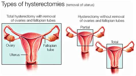 hysterectomy reasons types of hysterectomy and hysterectomy