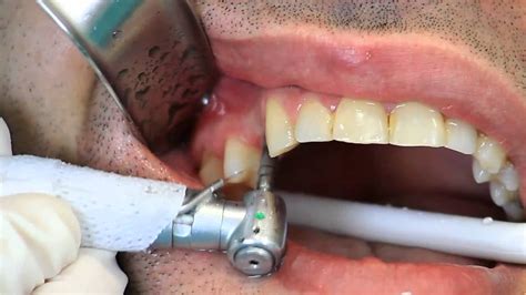 implante dentário quanto custa consulta ideal