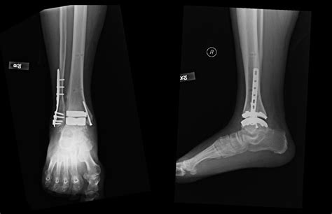 leading edge developments  total ankle arthroplasty keck medicine