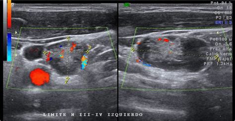 lymphoma lymph nodes ultrasound