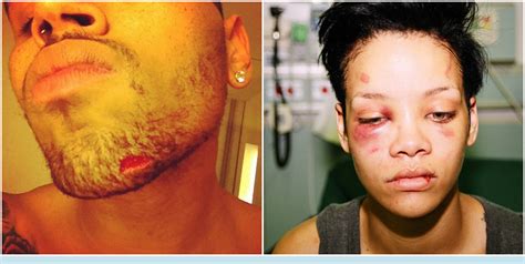 Chris Brown Gets Boo Boo In Bar Fight Still Doesn T Know