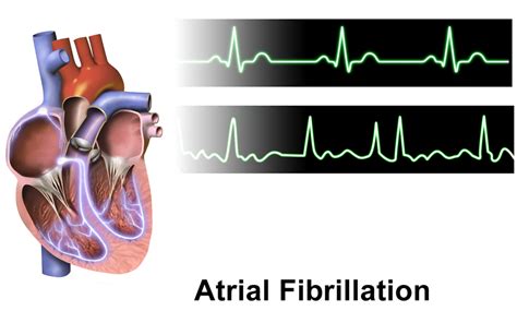 atrial fibrillation physiopedia