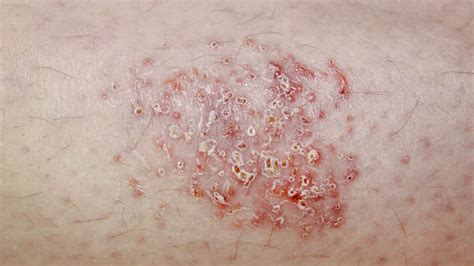 vesicle skin lesion