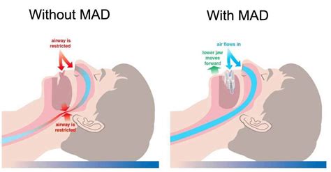 mandibular advancement device perth cpap