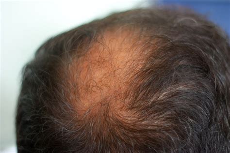hair loss  symptoms   cures  hair loss geeks