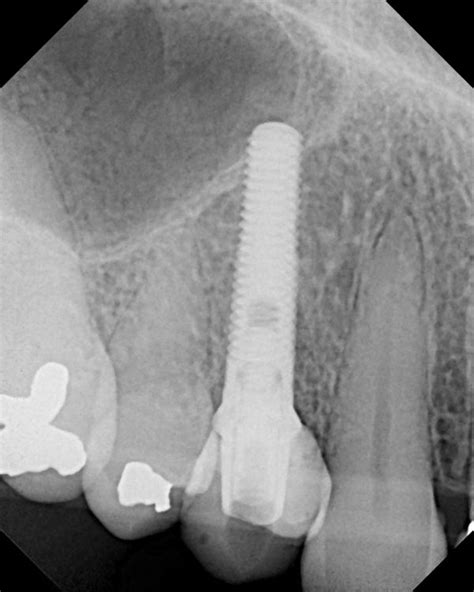 Dental Implant X Rays Dental Implant Dentistry Blog