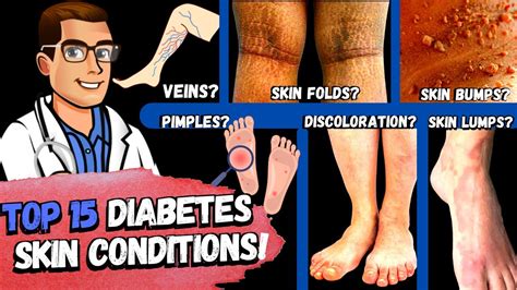 top  diabetes skin signs symptoms type   diabetes mellitus