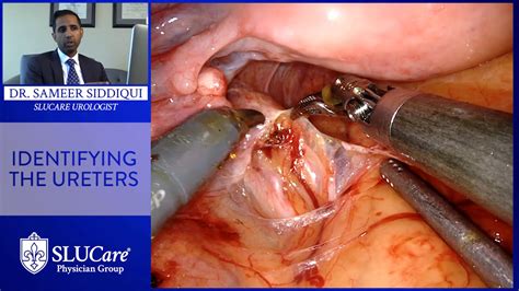 Robotic Cystectomy Procedure To Remove Bladder Slucare Urology Youtube