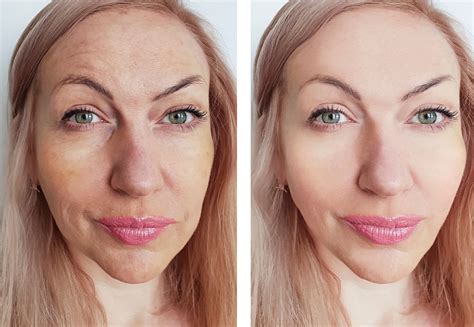 skin care  makeup tips  laser resurfacing reston va