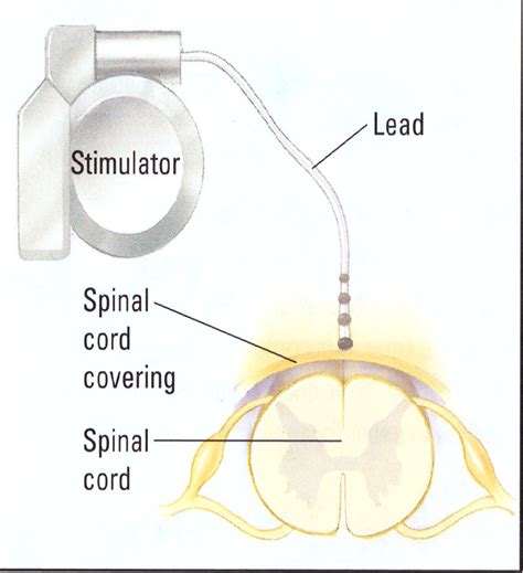 spinal cord stimulator chronic pain richardson sunnyvale tx