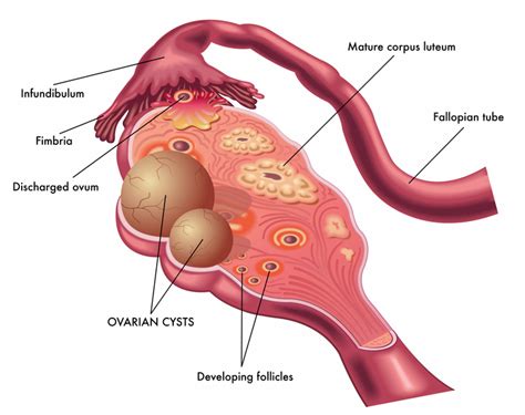 ovarian cyst symptoms how they develop how to treat them university