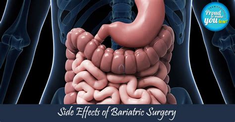 Bariatric Surgery Side Effects Risks And Complications