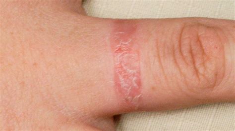 contact dermatitis  symptoms  treatment