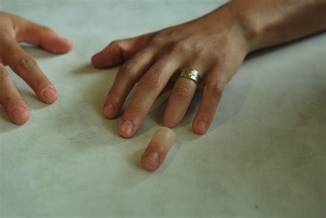 finger prosthesis  amputee