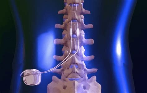 spinal cord stimulator implants  star pain management