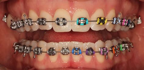 metal braces peninsula orthodontics