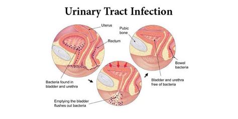 Best Urinary Tract Infections Treatment And Diagnosis India