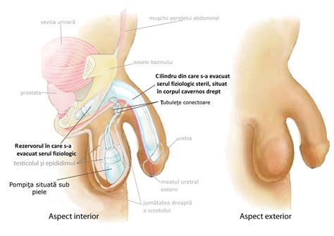 Penile Implant Uretro Genital Reconstruction Center