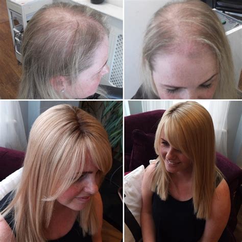 hair solveds solution   types  female hair loss  thinning