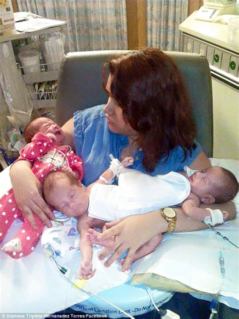 conjoined twins ximena and scarlett hernandez torres get