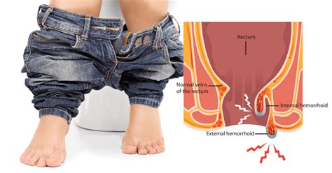 rectal bleeding causes 5 natural home remedies dr axe