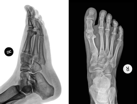 common types  ankle fractures simon moyes