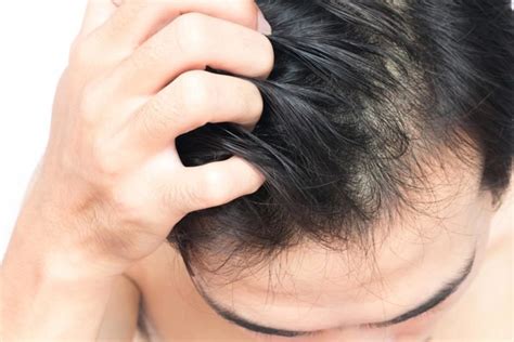 Gambaran Klinis Infeksi Jamur Pada Kulit Kepala Dan Rambut