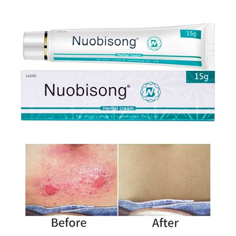 15ml Nuobisong Face Skin Care Treatment Face Pimples Scar Stretch Marks