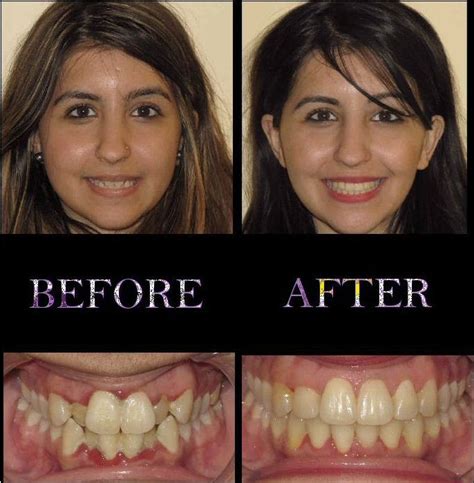Checkout Before And After Orthodontics Treatment Photos Of Patients