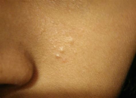small bumps  arent pimples  face general acne discussion