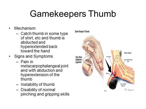 gamekeepers thumb signs symptoms new porno