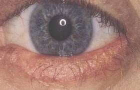 treat eyelid mites eyelash demodex mites