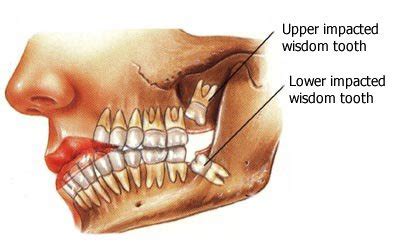 wisdom teeth removal  extraction  wisdom teeth richmond va