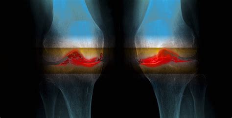 stem cells  knee problems  doctors investigate wsj