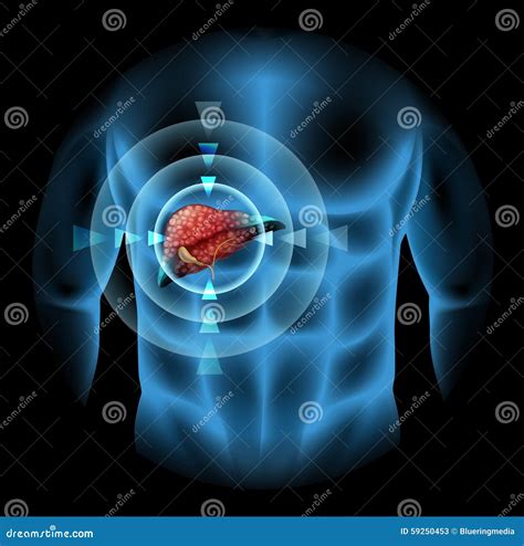 sclerosis diagram  human body stock vector illustration  illness body
