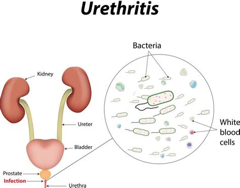 ngu non gonococcal urethritis symptoms treatment std ngu