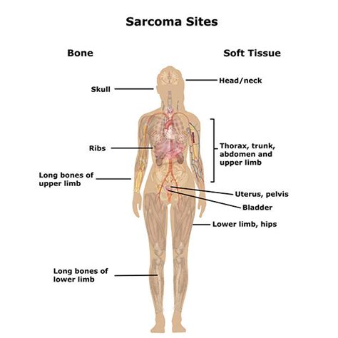 bone and soft tissue sarcoma risk after retinoblastoma