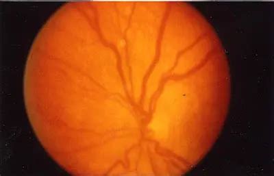 diagnosis   disease  retinopathy  prematurity american